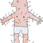 Maatskappy 7 beeld ACUPUNCTURE CLINIC-SHAUL FREEDMAN wet cupping in Cape Town WC